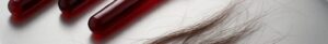 Blood test vials beside hair strands on lab tray for hair loss diagnosis in Basingstoke